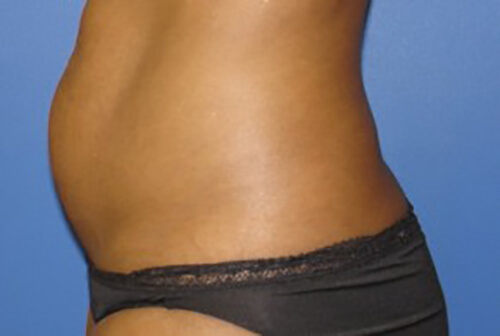 Liposuction Before and After | Flawless Skin