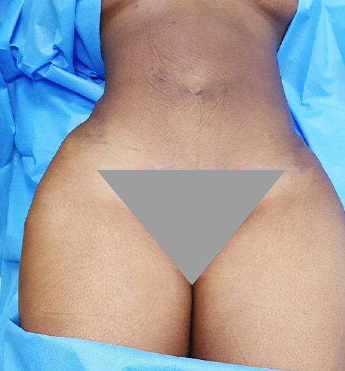 Liposuction Before and After | Flawless Skin