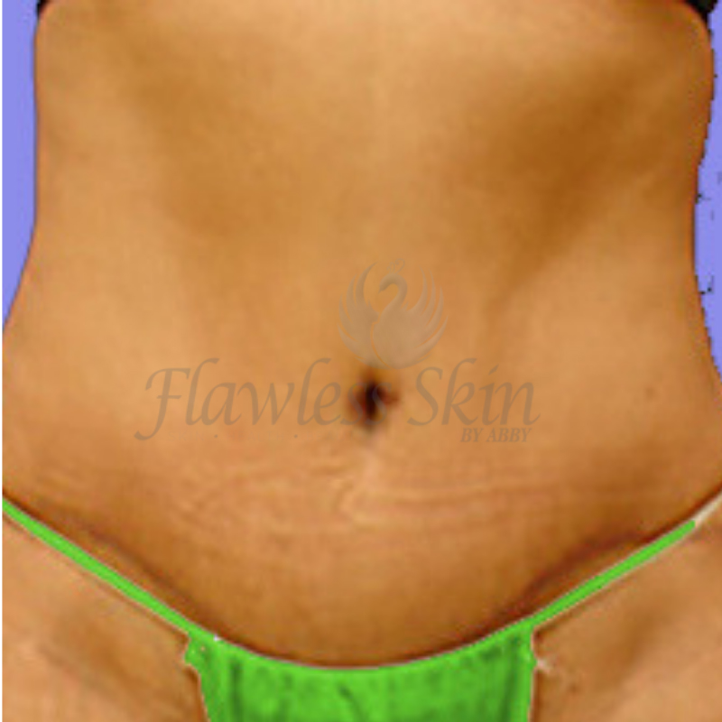 Tummy Tuck Before and After | Flawless Skin
