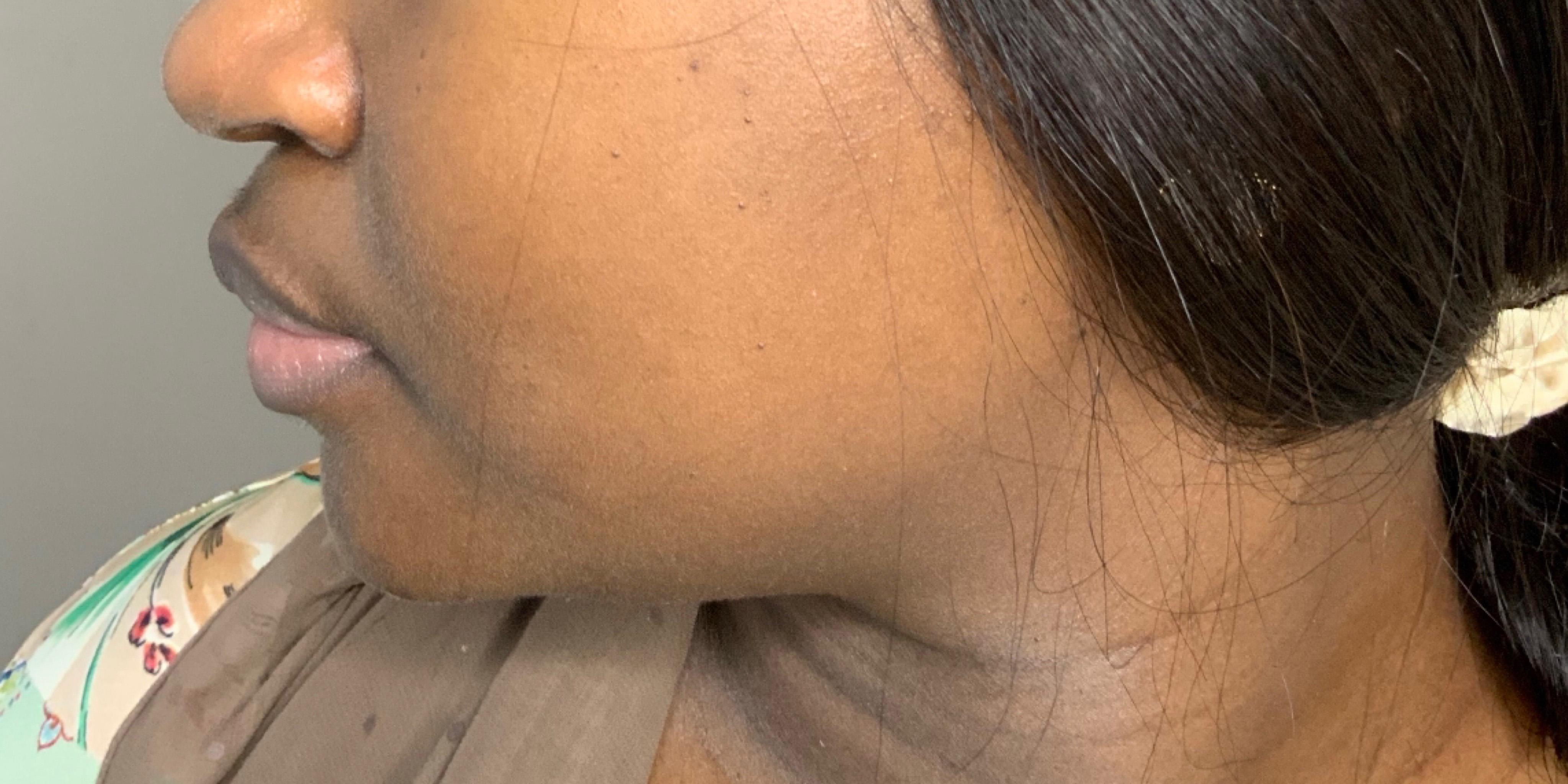 Chin Augmentation And Kybella Before and After | Flawless Skin