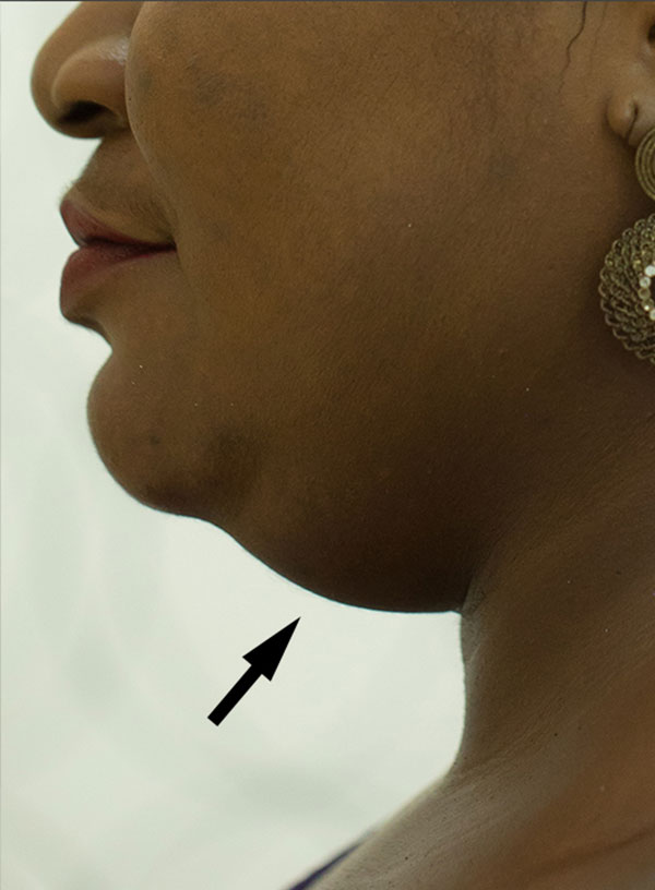 Chin Augmentation And Kybella Before and After | Flawless Skin