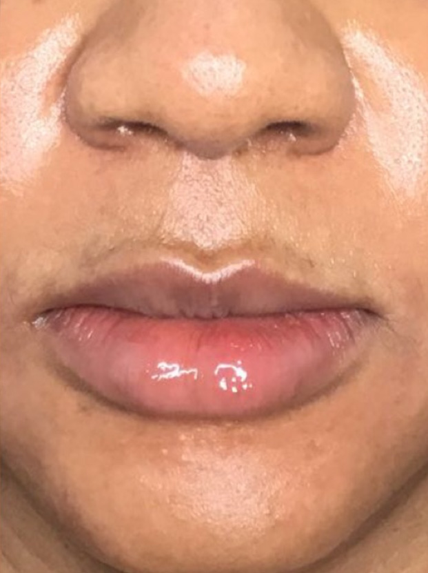Lip Augmentation Before and After | Flawless Skin