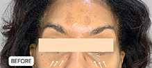 Tear Trough And Under Eye Fillers Before and After | Flawless Skin