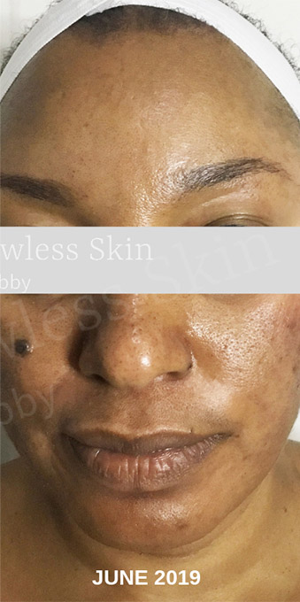 Acne Facial Procedure Before and After | Flawless Skin
