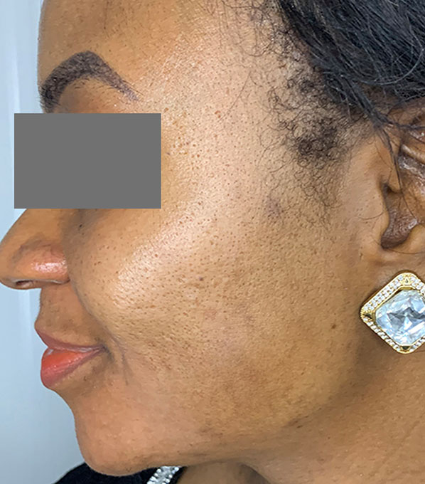 Chemical Peels Before and After | Flawless Skin