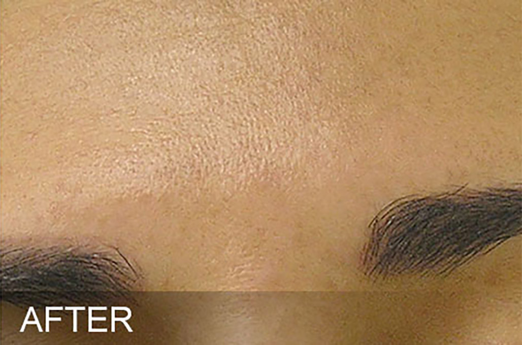 Hydrafacial Before and After | Flawless Skin