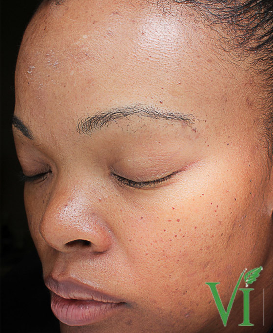 Hyperpigmentation Before and After | Flawless Skin