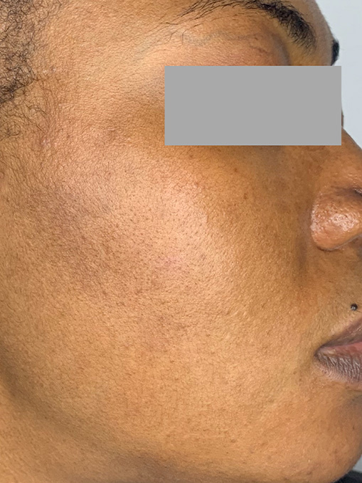 Skin Resurgacing Before and After | Flawless Skin